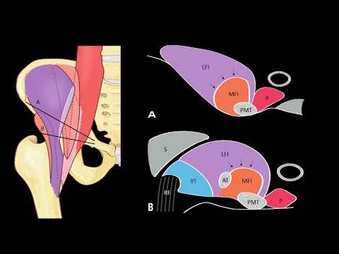 Groin pain and ultrasound - part 4 - Anterior aspect of the hip and olio psoas muscle