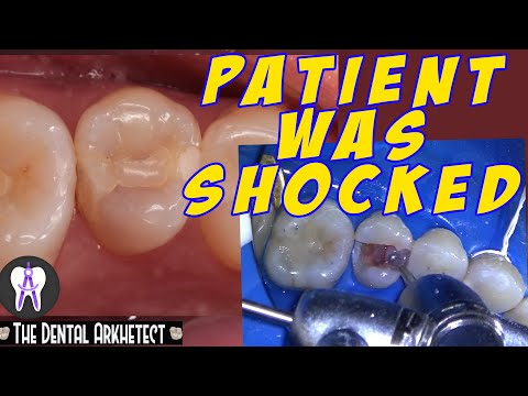 Tooth Restoration Patient Complained on an existing Tooth Restoration 