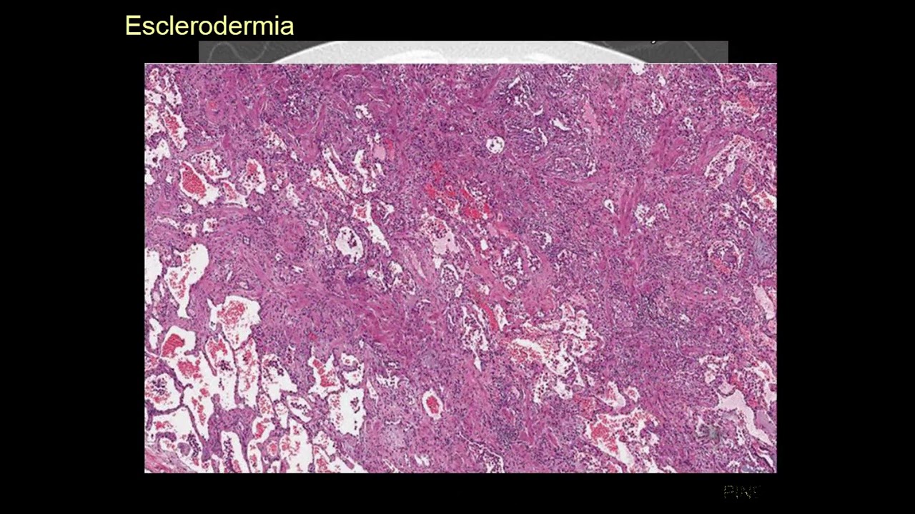 Intersticiopatia nas colagenoses
