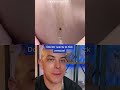 Crazy Tick Removal | Doctor Reacts