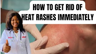 How to get total rid of heat rashes immediately |do
