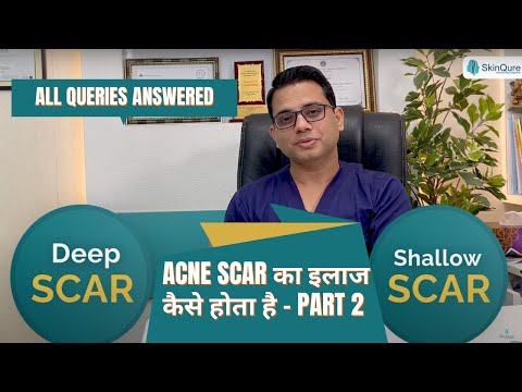 How is the treatment for Acne Scars done? Part -2  - Explained by Dr. Jangid | SkinQure | Delhi