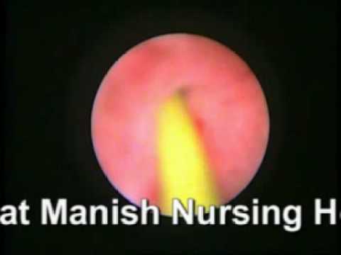 Diagnostic hysteroscopy in infertility work-up operative video