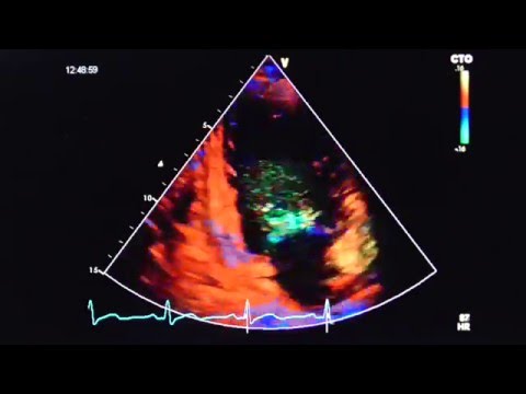 2-Kammerblick mit Gewebedoppler (2-chamber view with tissue doppler)