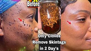 diy skin tag removal in 3 day quickly, how to remove skin tag removal with lemon