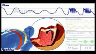 Hypopneas &amp; Apneas in Sleep Apnea