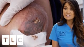 Spoon Is Used To Remove Man&#39;s Cyst! | Dr. Pimple Popper