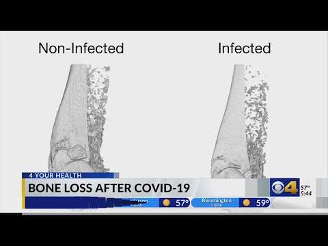 IU researcher uncovers link between bone loss and COVID in mice