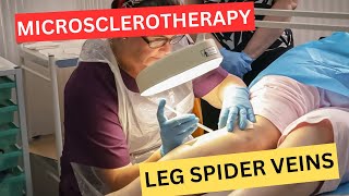 Leg Spider Veins: The Ultimate Guide to Microsclerotherapy Treatment by UK Vein Expert