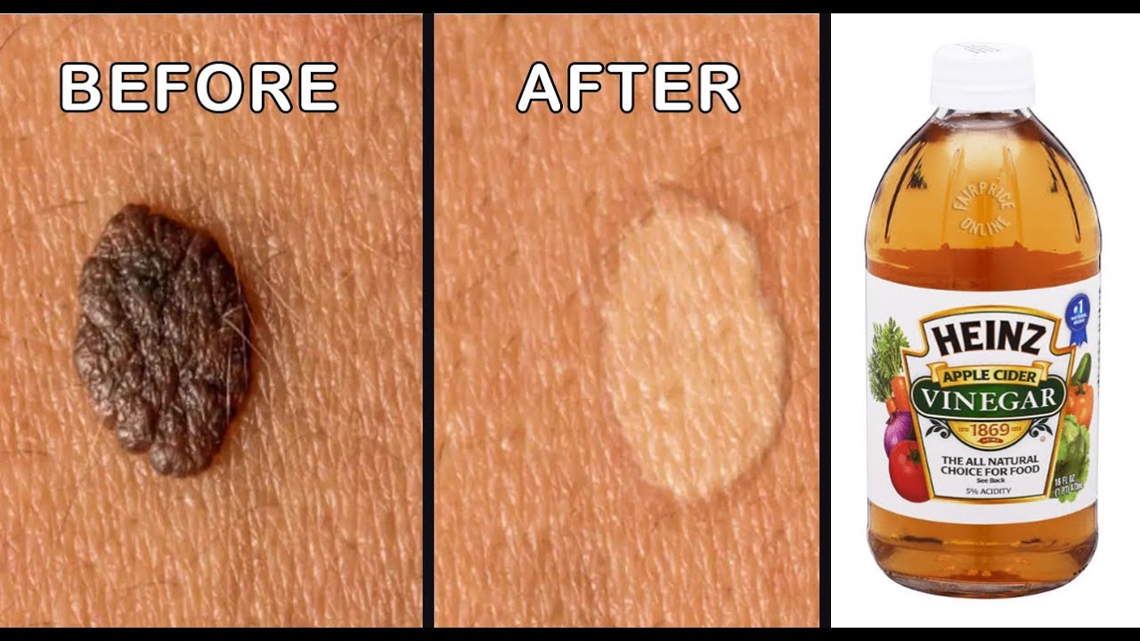 Is it safe to remove moles with apple cider vinegar? Tipseri
