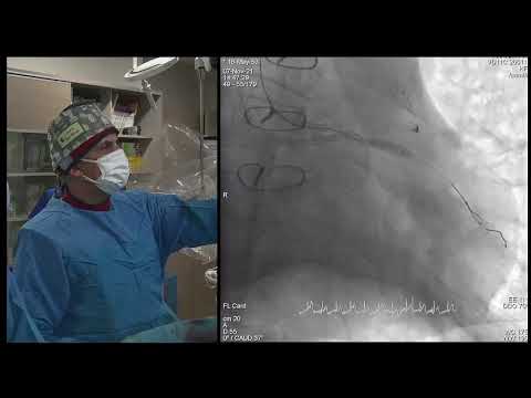 Epicardial Perforation during LCX CTO PCI and good sealing with coronary coils