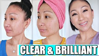 Laser Away Clear &amp; Brilliant Review | Laser Facial for Acne, Scars, Wrinkles, Large Pores, Texture