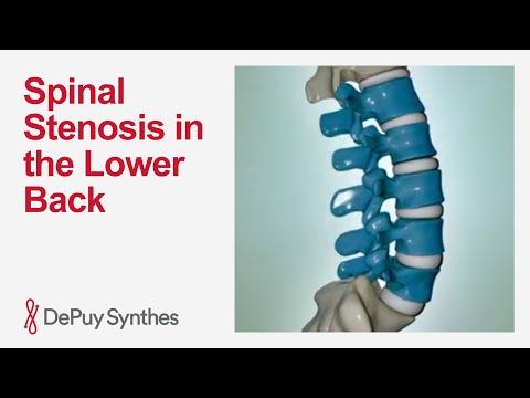 Lumbar Spinal Stenosis: Lower Back Pain Causes, Symptoms and Treatment | DePuy Synthes