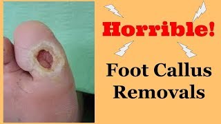 Horrific Foot Callus Removal