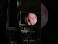 Removing A Sinus Fungus Ball From A Patient S Nose Nose Allergy Allergies Snot
