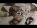 Richard III - Discovering the Fatal Blow - YouTube