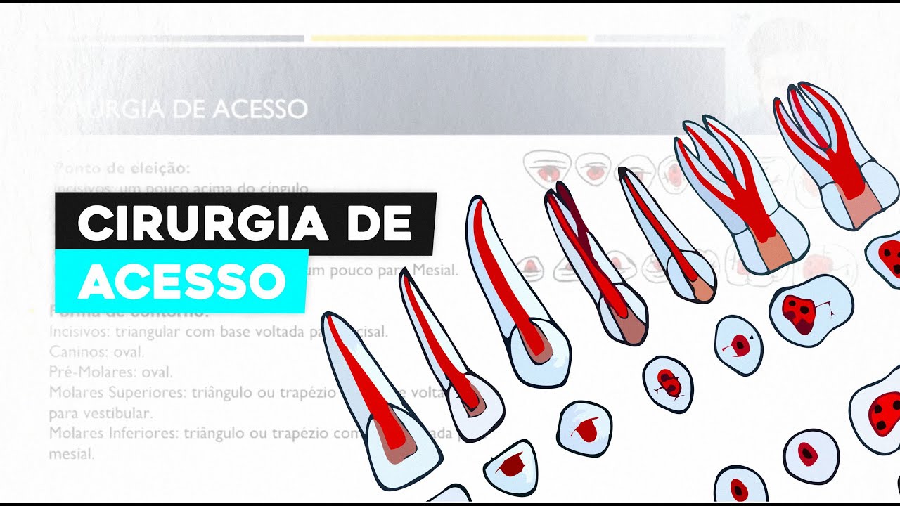 Cirurgia de Acesso Endodôntico: Guia Completo para Dentistas Iniciantes