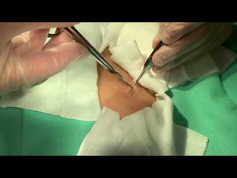 Back Cyst Extraction