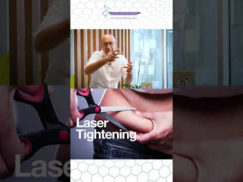 laser-tightening