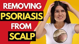 Removing psoriasis from scalp |  How to get rid of scalp psoriasis