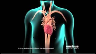 Catheter Ablation