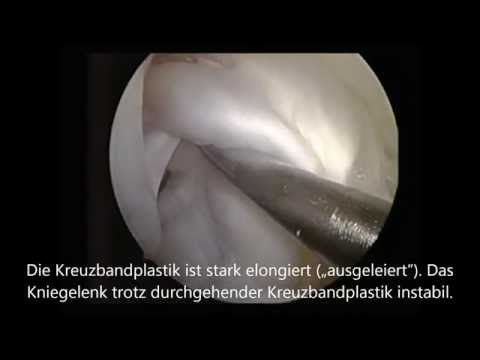 Schwindel Symptom der zervikalen degenerative Scheibenerkrankung Behandlung von Osteoarthritis des Knies Magneto