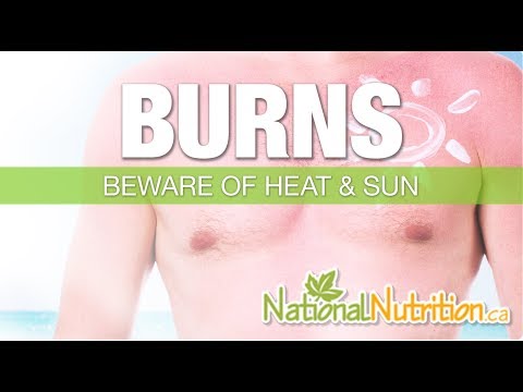 Burns & Sunburn