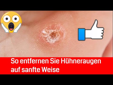Behandlung von Gelenken in den Fuß Rückenschmerzen von Pankreatitis zu unterscheiden