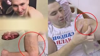 Терешину вырезали всю дрянь! Кадры. Он сожалеет до слёз. Руки Базуки после удаления синтола