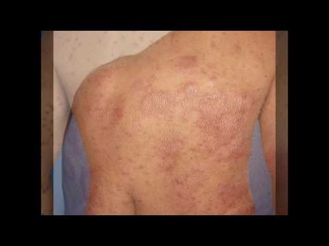 ความดันโลหิตโรคสะเก็ดเงิน ไม่ว่าจะเป็นไปได้ที่จะย้อมผมที่มีแผลเปื่อย