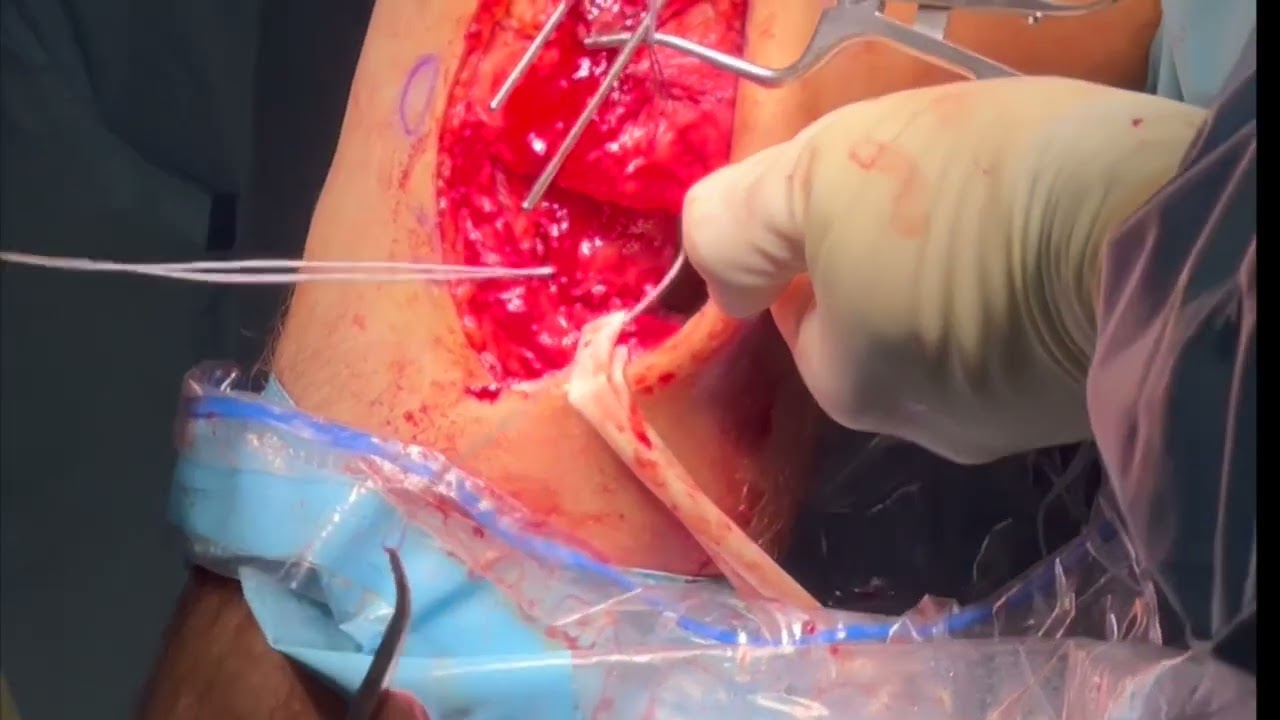 Posterior Lateral Corner Reconstruction