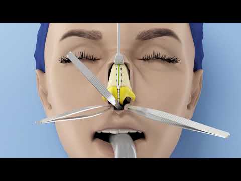 CIRURGIA PLASTICA - RINOPLASTIA