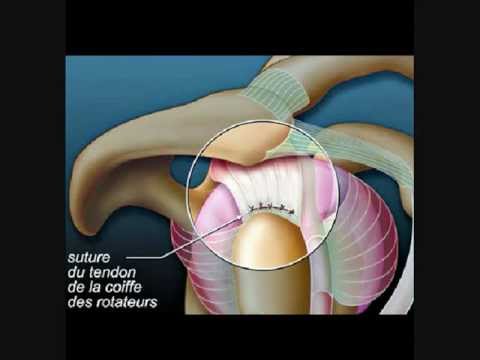 comment soigner fissure tendon epaule