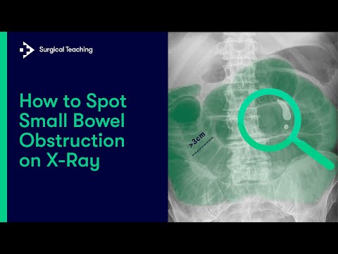 Small Bowel Obstruction | How do we Diagnose it on Abdominal X-Ray?