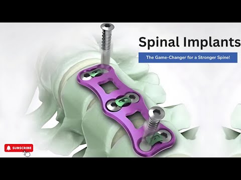 Spinal Implants: Support for Your Spine | Dr. Ajay Kothari