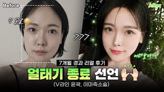 [리얼모델 VLOG] 얼태기 종료 선언｜V라인 윤곽, 이마축소술 7개월 경과 리얼 후 #일퍼센트성형외과