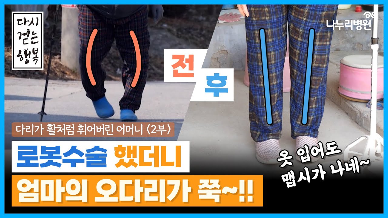 다리가 활처럼 휘어버린 어머니 무릎 인공관절 수술