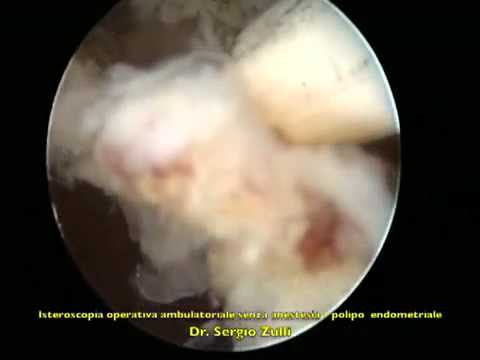 Vertigini con osteocondrosi cervicale della medicina tradizionale La terapia Esercizio in lussazione dellarticolazione della spalla