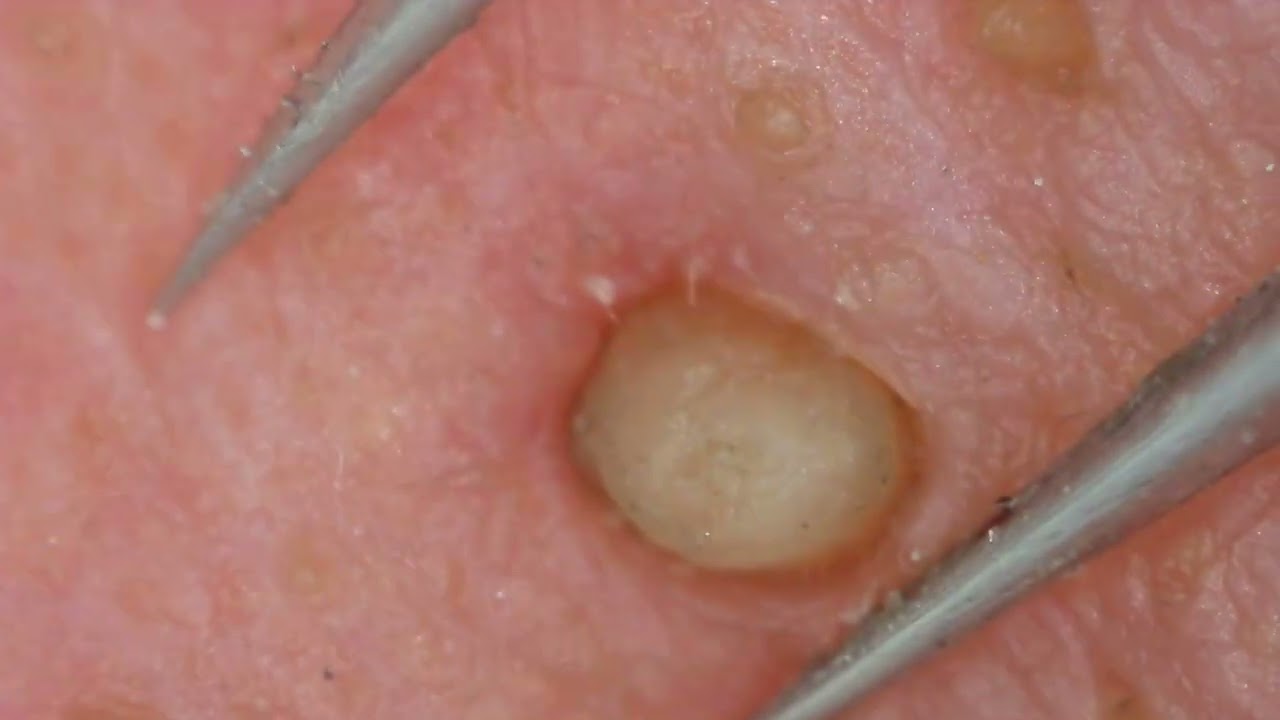 0332 keratin plug removal nose