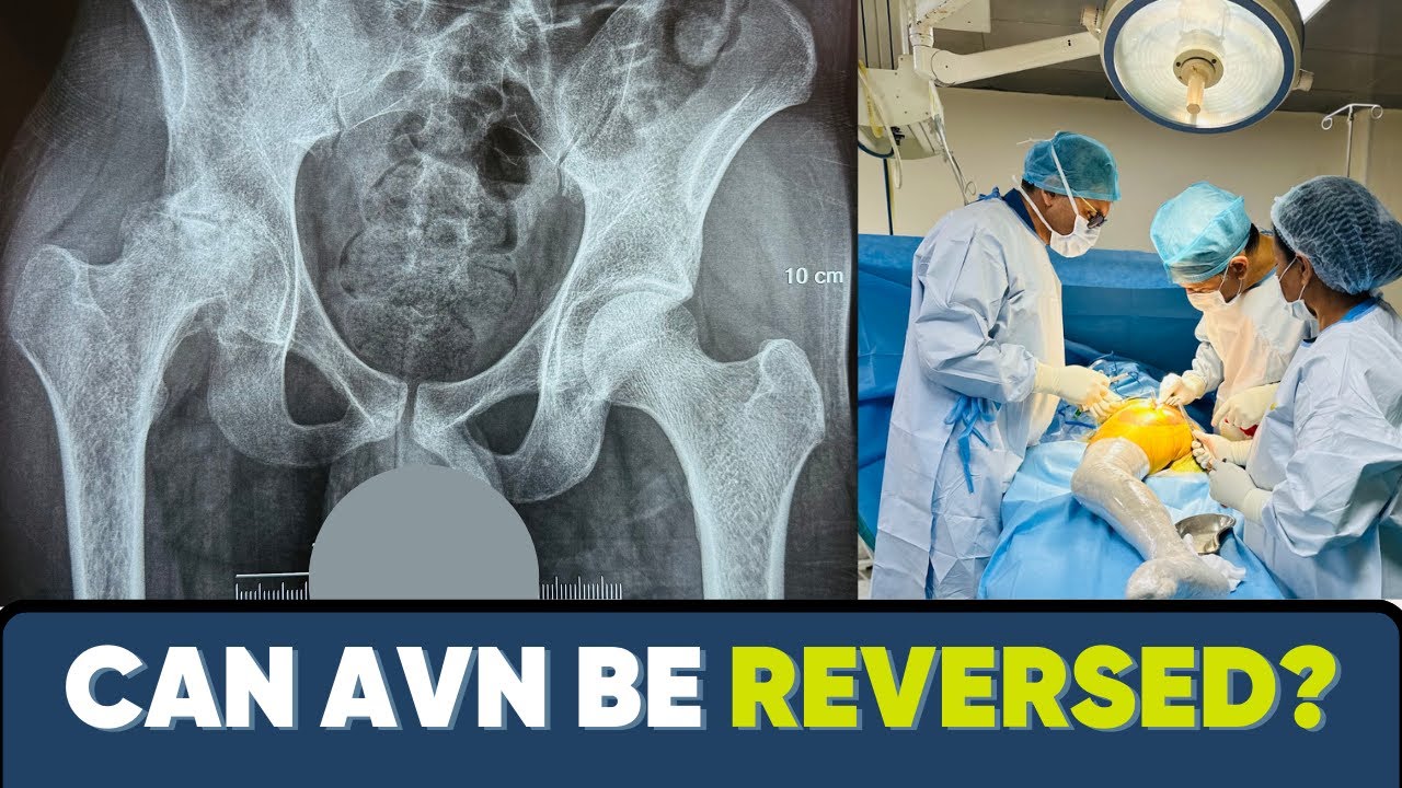 Can AVN be reversed? Doctor busts myth!