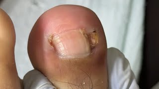 Ep_8695 Big ingrown toenail removal 👣 ผมทำลายสถิติของพี่หรือครับ 😅 (clip from Thailand)