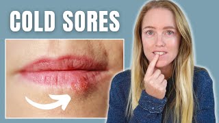 #1 Tip to Stop a Cold Sore Fast and Naturally! (Without a Prescription)