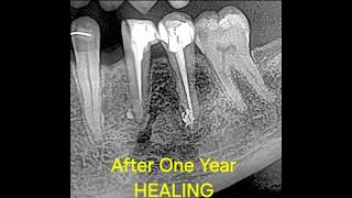 Why periapical lesions heal nonsurgically.