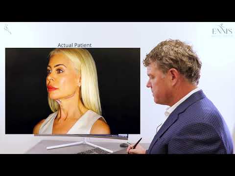 myEllevate Neck Lift Procedure