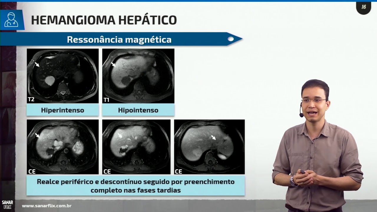 Nódulos hepáticos benignos - Aula SanarFlix