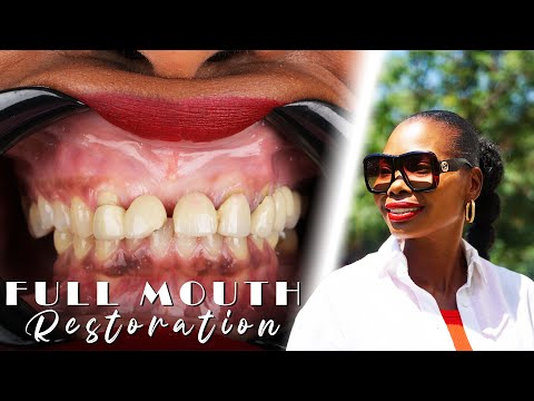 Full Mouth Restoration / onial