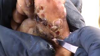 Emmanuel of Msalaba, Busia County Jigger Dug (1 of 5)