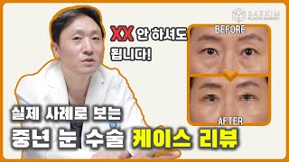 눈가 처짐 그냥 둘 건가요? 중년 눈성형 실제 수술 케이스 리뷰 확인하세요!