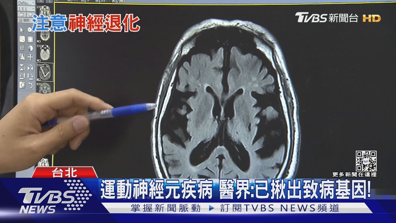 臨床常見「腦神經退化性疾病」出現這幾種症狀 勿拖延!
