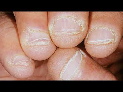 Îndepărtați unghiile de la picioare cu ciupercă